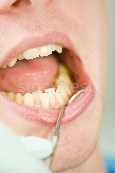 Congestioned teeth Stock photo © Lighthunter