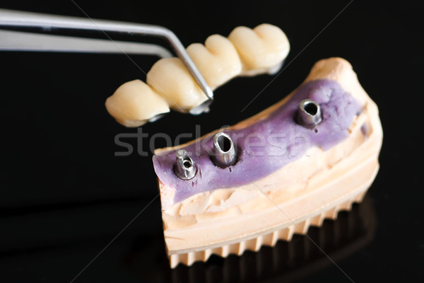 Stok fotoğraf: Diş · implant · kafa · köprü · dişçi · teknisyen