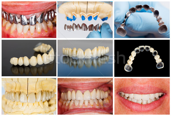 Technical steps of dental bridge Stock photo © Lighthunter