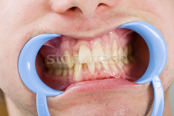 Fogak fogorvos megvizsgál jó példa fogászati Stock fotó © Lighthunter