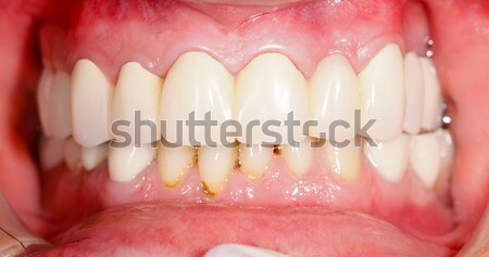 Metal base dentales puente cerámica boca Foto stock © Lighthunter