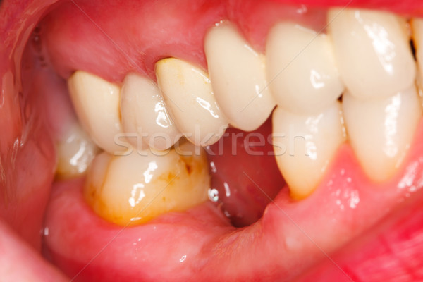 Denture Stock photo © Lighthunter