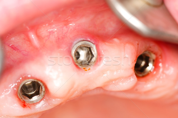 A macro shot of dental implants in the oral cavity (human mouth). Stock photo © Lighthunter