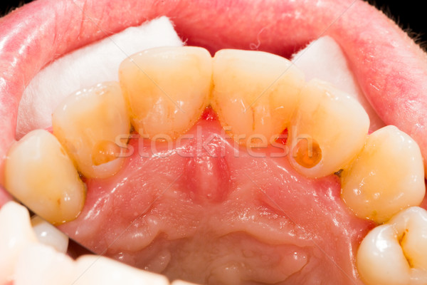 Dental Pulp Treatment Stock photo © Lighthunter
