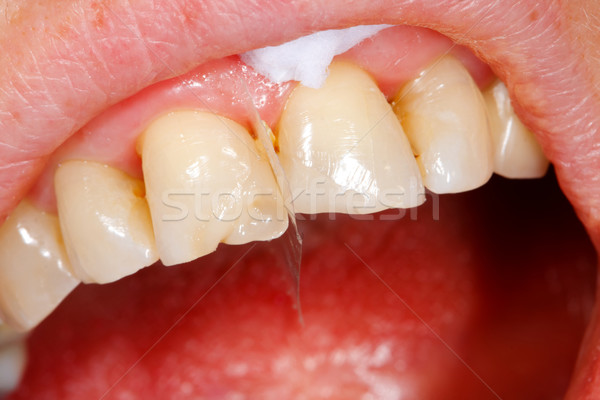 Riempimento dente trattamento rotto materiale Foto d'archivio © Lighthunter
