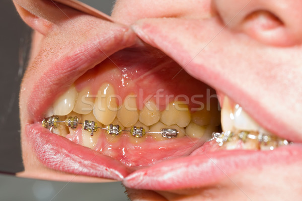 Dental braces on teeth - orthodontic treatment Stock photo © Lighthunter