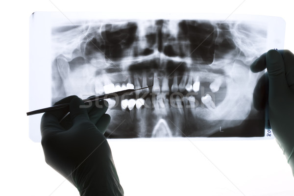 A closeup of a panoramic radiography, a dentist holding it in her hand, pointing with a probe Stock photo © Lighthunter