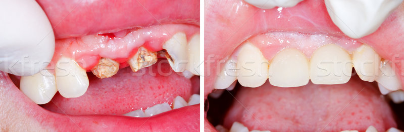 Teeth root rest before and after treatment Stock photo © Lighthunter