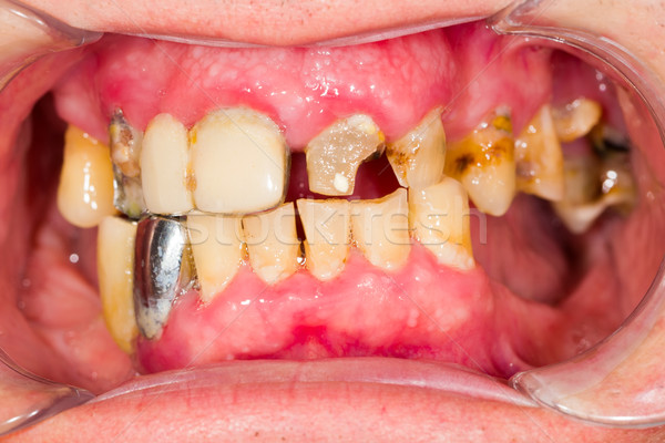 Descuidado boca dentales tratamiento trabajo salud Foto stock © Lighthunter