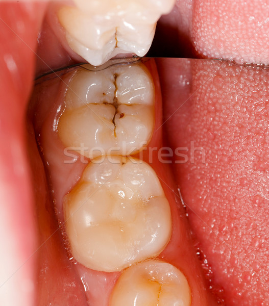 Cavitate dinţi uman tratament rar unghi Imagine de stoc © Lighthunter