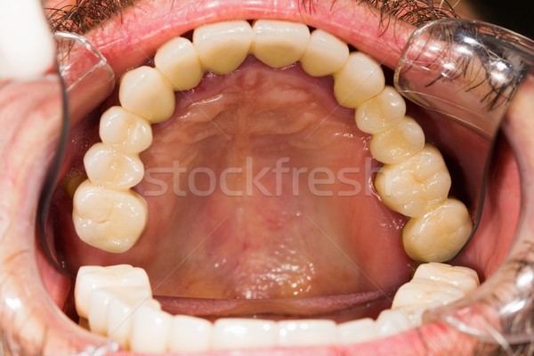 Diş köprüler dişler köprü çalışmak tıbbi Stok fotoğraf © Lighthunter