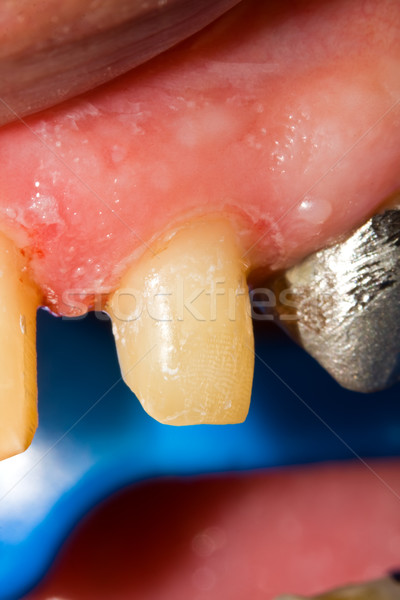 Zähne Rehabilitation Makro erschossen Zahn zahnärztliche Stock foto © Lighthunter