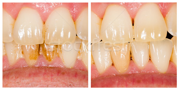 Verwijdering tandheelkundige behandeling kantoor werk Stockfoto © Lighthunter