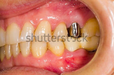 Dental Work Stock photo © Lighthunter