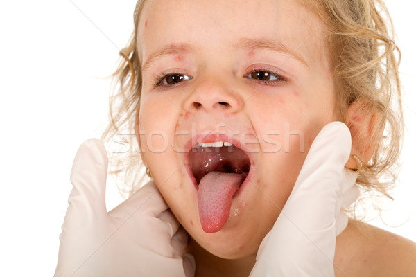 Kid face with small pox  consulted by a physician Stock photo © lightkeeper