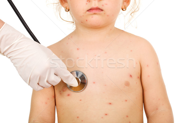 Little kid with small pox at the physical exam Stock photo © lightkeeper