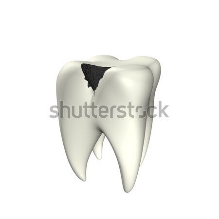 Caries Tooth 3D Stock photo © limbi007