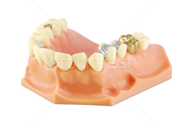 Dental model (with different treatments) Stock photo © luissantos84