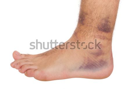 Stock photo: Ankle Sprain