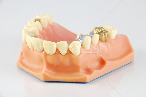 Dental model (with different treatments) Stock photo © luissantos84