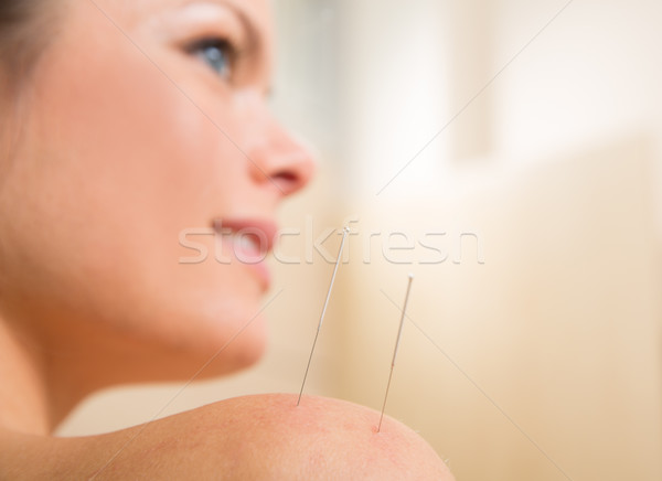 Acupuncture needle pricking on woman shoulder Stock photo © lunamarina