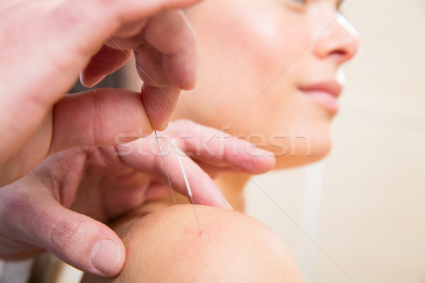 Stock photo: Doctor hands acupuncture needle pricking on woman