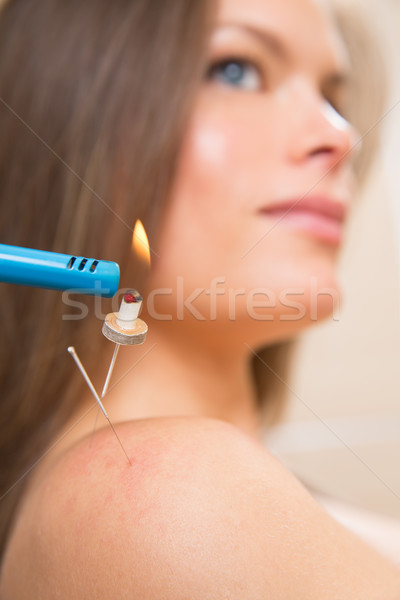 Stockfoto: Naalden · warmte · vrouw · schouder · gezondheid