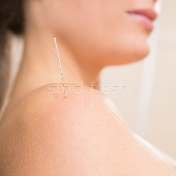 Stock photo: Acupuncture needle pricking on woman shoulder