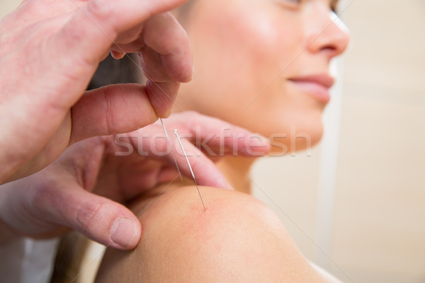 Stock photo: Doctor hands acupuncture needle pricking on woman