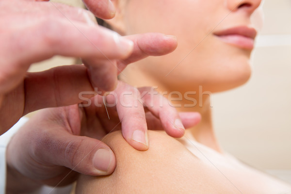 Orvos kezek akupunktúra tű nő beteg Stock fotó © lunamarina