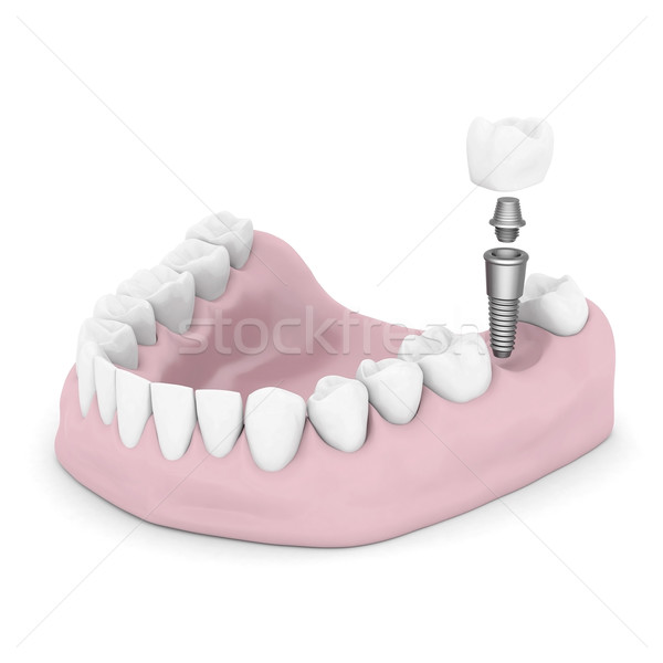 Tandheelkundige geïsoleerd witte medische ontwerp technologie Stockfoto © mastergarry