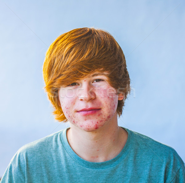 Smart Junge Pubertät Akne Gesicht Stock foto © meinzahn