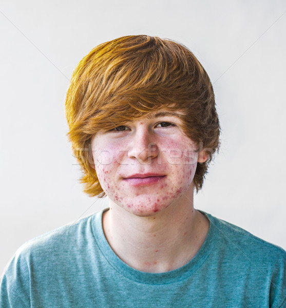Smart Junge Pubertät Akne Kind Stock foto © meinzahn