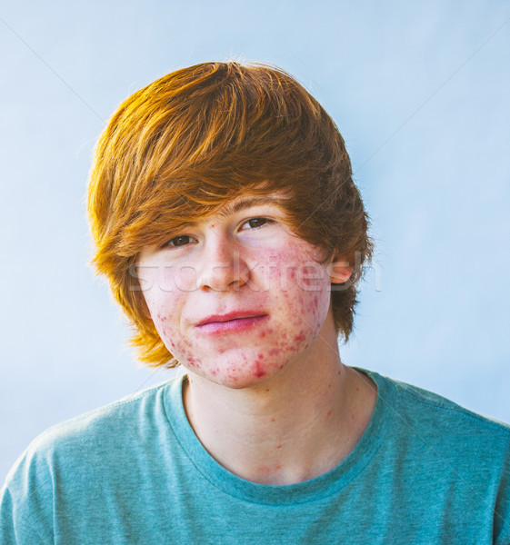Okos fiú serdülőkor pattanás vidám fiú arc Stock fotó © meinzahn