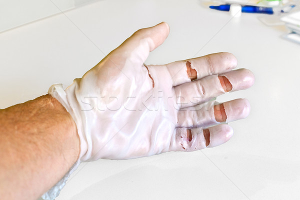 hand physiotherapy to recover a broken finder Stock photo © meinzahn