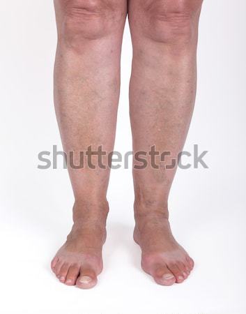 Old woman with varicose veins Stock photo © michaklootwijk
