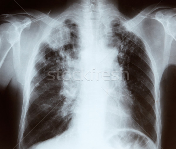 Chest x-ray Stock photo © monkey_business