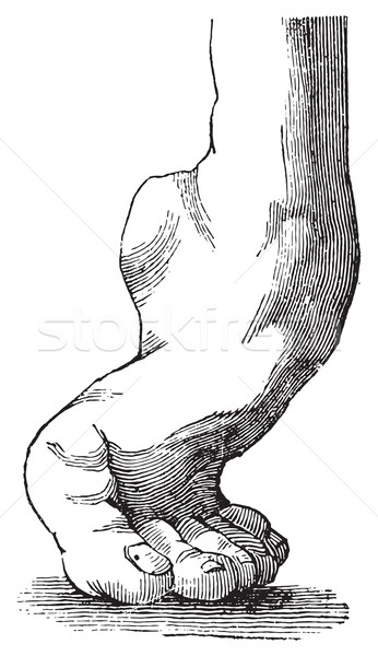 Stock photo: Equine clubfoot, vintage engraving.