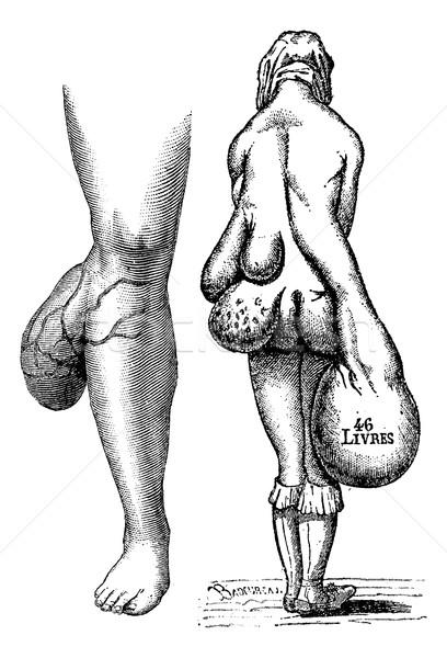 Fig. 767. Lipomas leg, Fig. 768. Multiple lipomas in a woman, vi Stock photo © Morphart