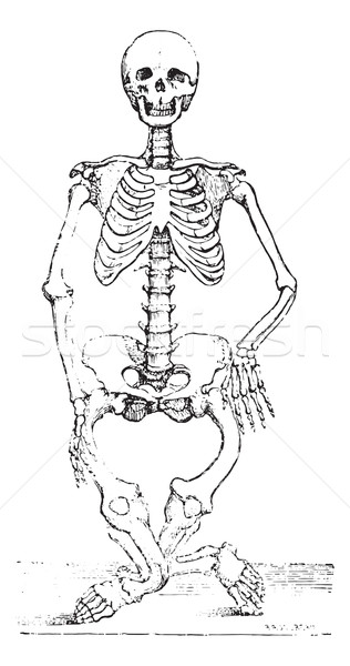 Skeleton deformed by rickets, vintage engraving. Stock photo © Morphart