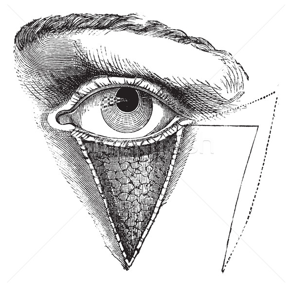 Fig. 179. Blepharoplasty by the method of Dieffembach, vintage e Stock photo © Morphart