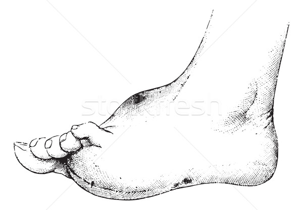 Perforating ulcer of the left foot in a woman with paralysis gen Stock photo © Morphart