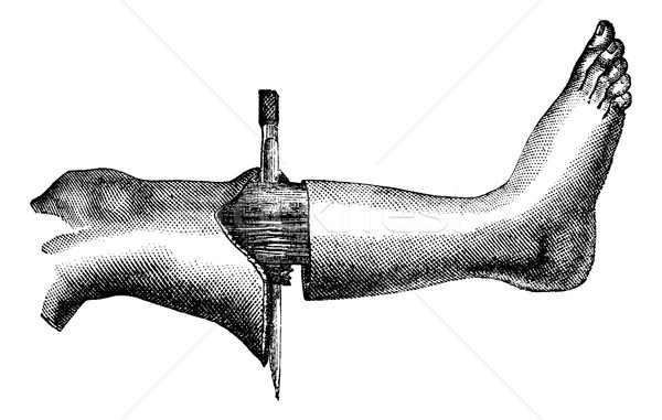 Amputation of the leg by the method has two flaps (circular inci Stock photo © Morphart