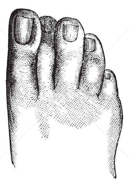 Faulty position of the second toe, vintage engraving. Stock photo © Morphart
