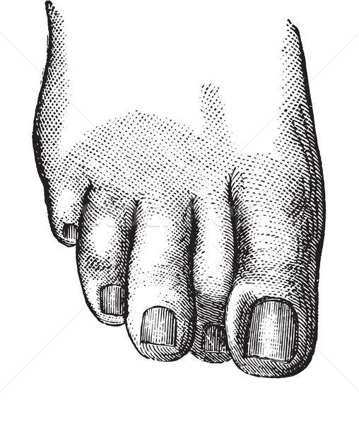 Defect pozitie al doilea deget de la picior cui epocă Imagine de stoc © Morphart