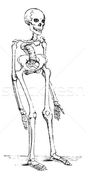 Skeleton deformed by rickets which deflected the spinal column, vintage engraving. Stock photo © Morphart