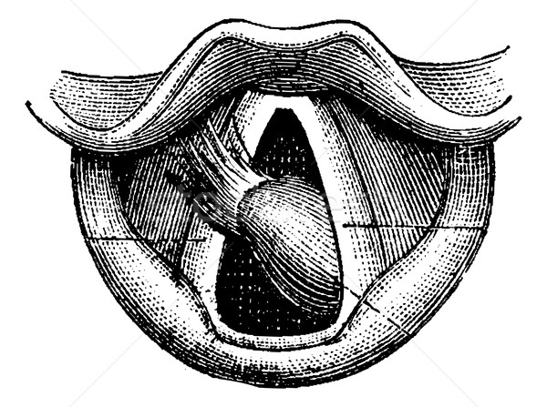 Fibroma of the Larynx, vintage engraving Stock photo © Morphart
