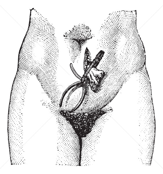 Ovariectomy or Oophorectomy, vintage engraving. Stock photo © Morphart