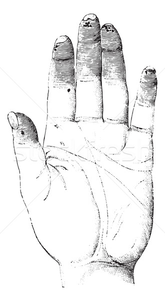 Sclerosis or Sclerotizis of the left hand (palmar surface), vint Stock photo © Morphart