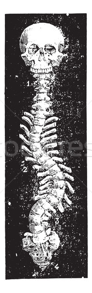 Scoliosis, vintage engraving. Stock photo © Morphart